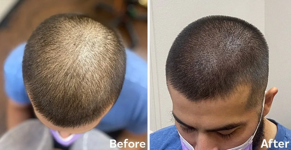 Scalp Micropigmentation Treatment