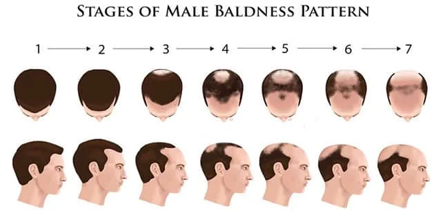 Baldness Stages