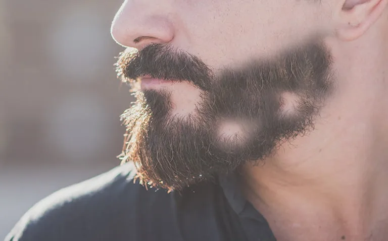 Beard Bald Spots