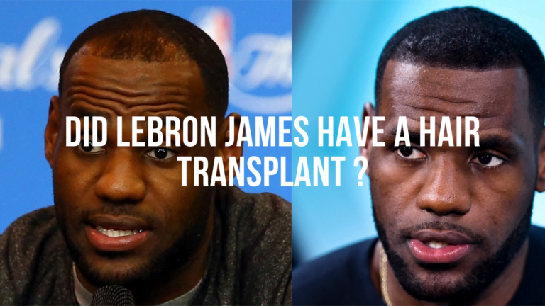 Did LeBron James have a hair transplant?