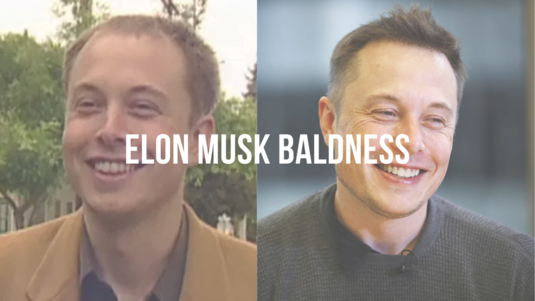 Did Elon Musk have a hair transplant?