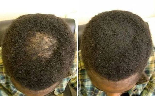 Hair Regrowth