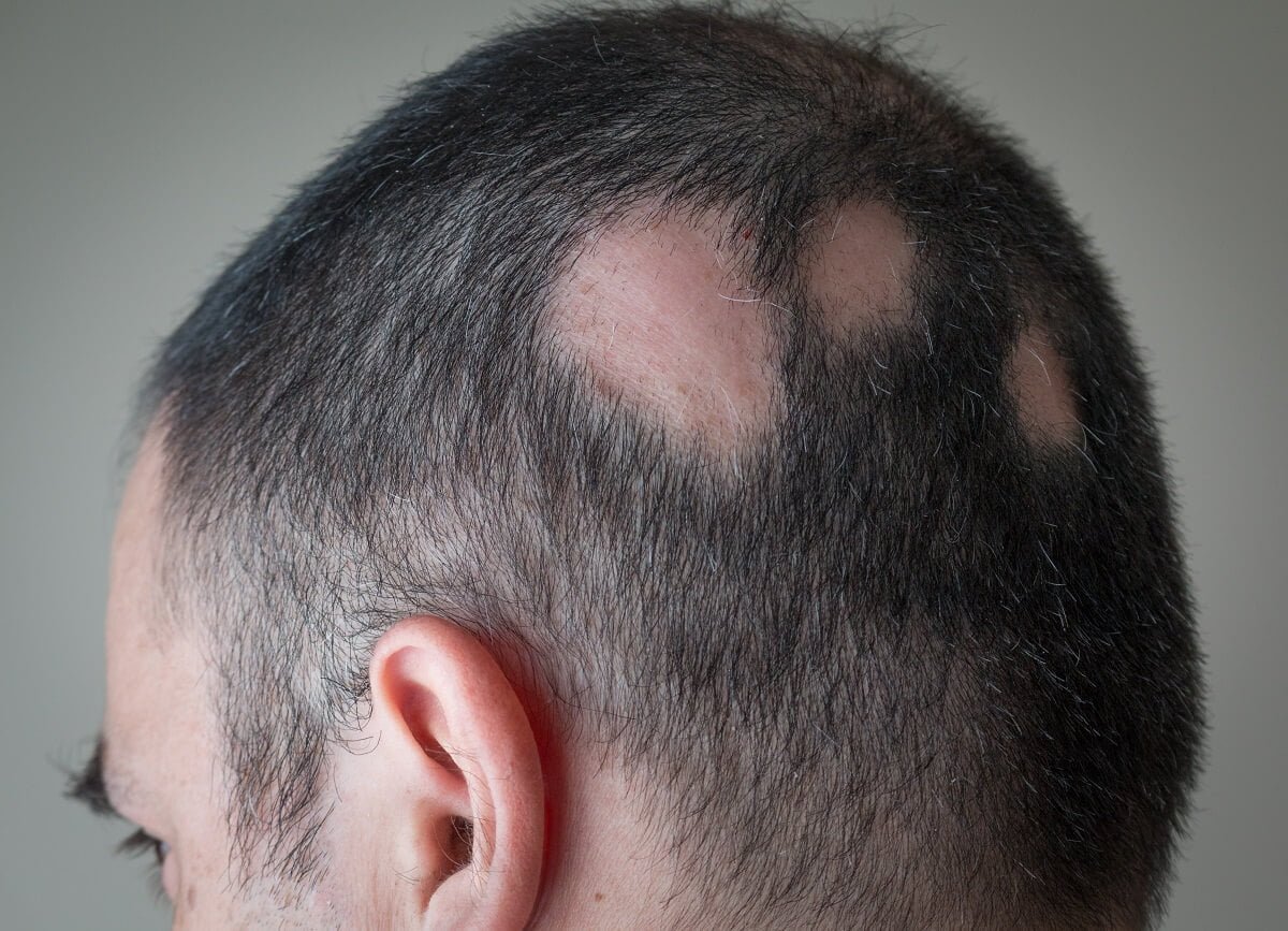 Scalp Ringworm: Can It Make You Permanently Bald? - Bald Lifestyle