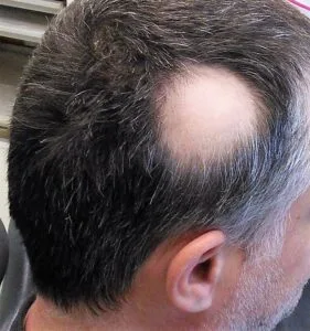 bald spot