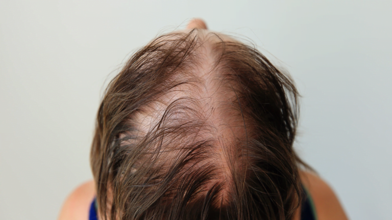 New Alopecia Drug Enters Phase 2 – Could it Help Severe Cases?