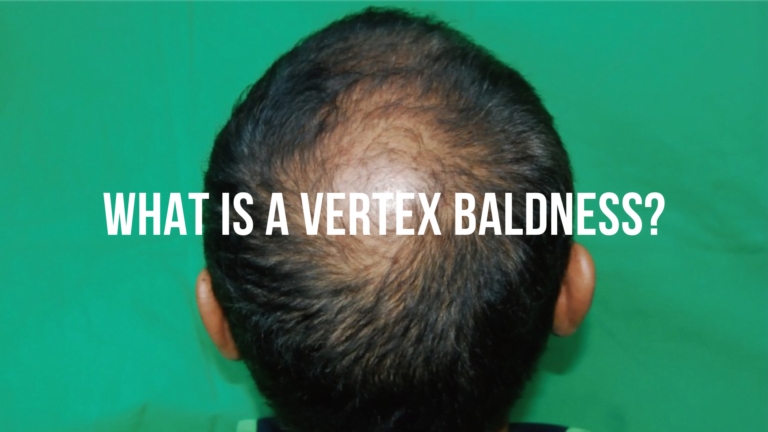 Understanding Vertex Baldness
